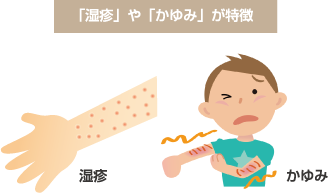 「湿疹」や「かゆみ」が特徴 湿疹やかゆみを表した画像